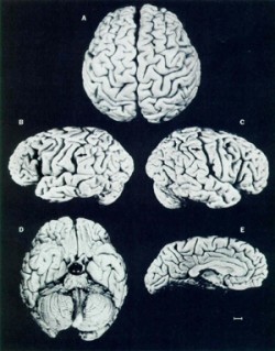 Einstein's brain. Removed for study in 1955, 7 hours after his death